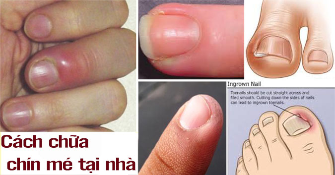 Chín mé - Hình ảnh minh họa